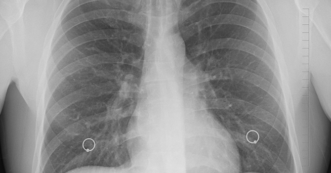 Screening for Lung Cancer Based on Risk Could Save Lives
