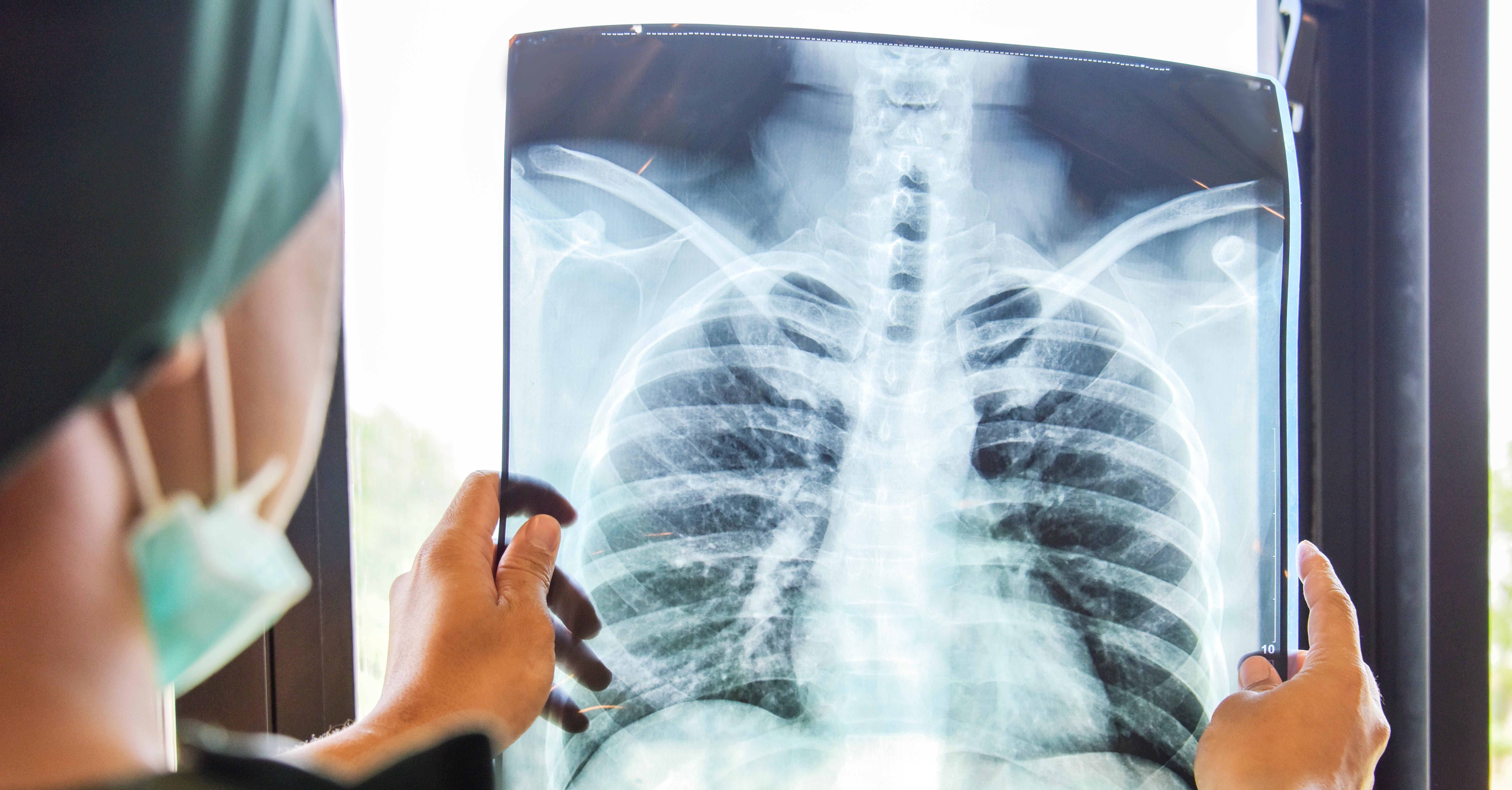 Predicting survival: Chest X-rays provide vital insight for hospitalized COVID-19 patients